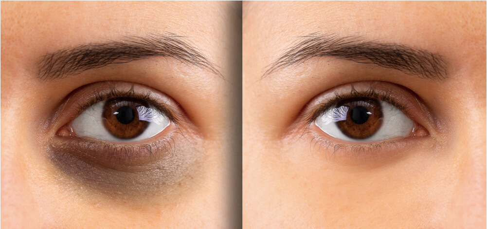 Thâm quầng mắt khiến bạn trông thiếu sức sống và mệt mỏi. Có cách nào cách hết thâm mắt nhanh chóng không?