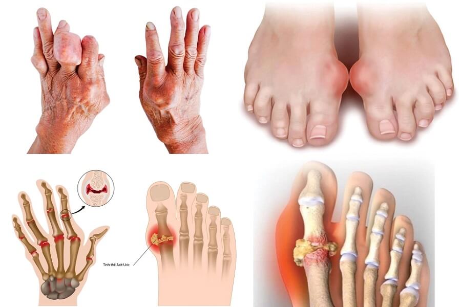 bệnh gout có chữa được không