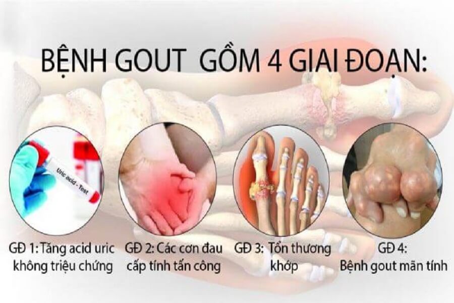 dấu hiệu bệnh gout