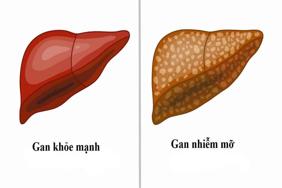 gan nhiễm mỡ độ 1