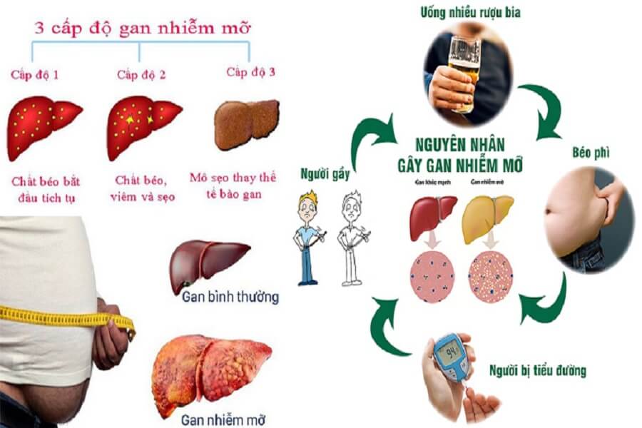 gan nhiễm mỡ độ 1