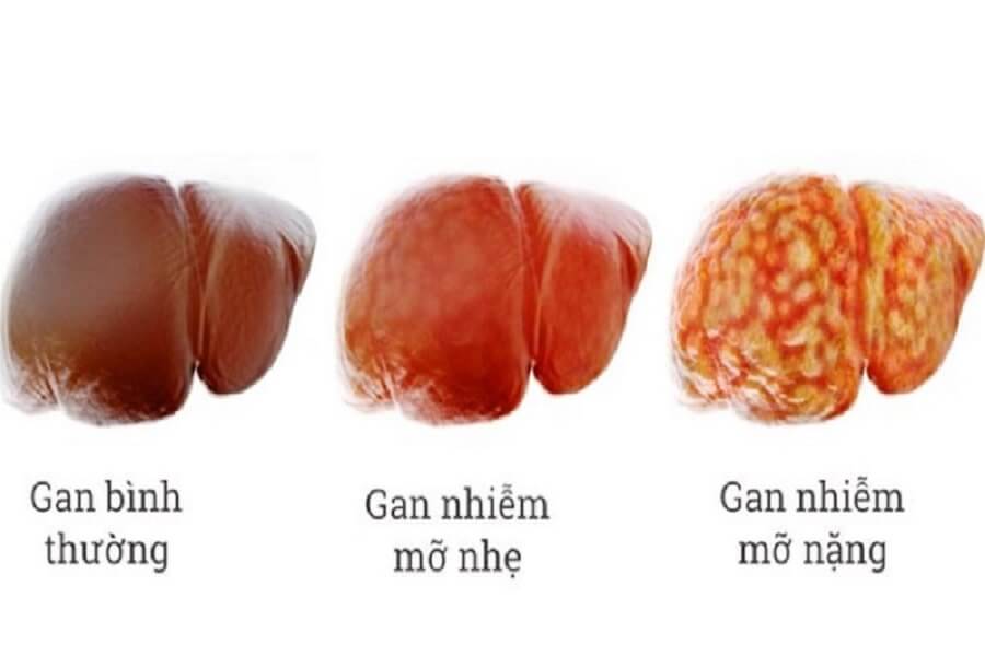 gan nhiễm mỡ độ 3