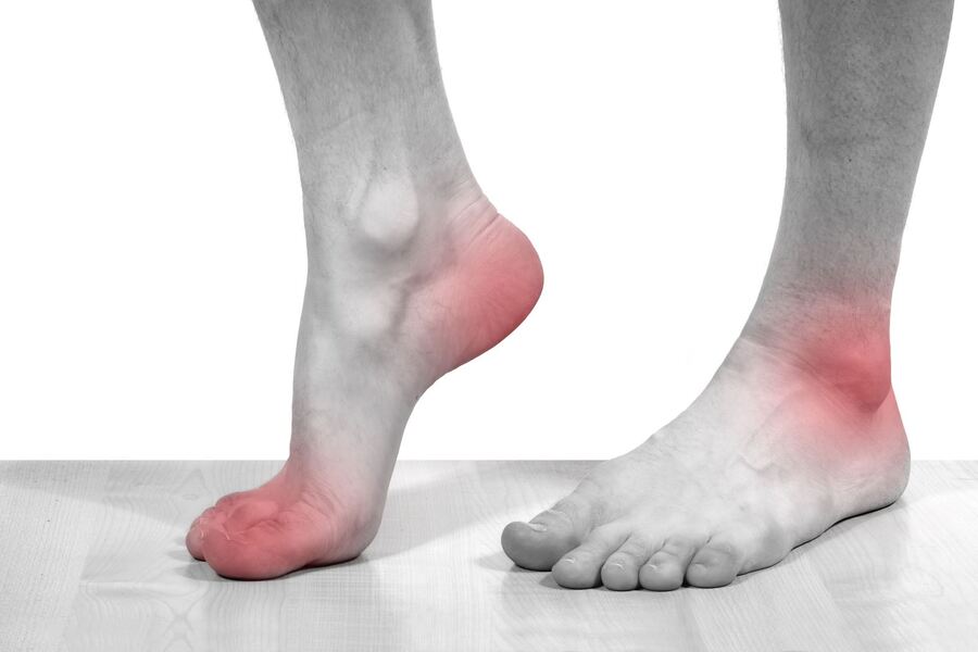 triệu chứng bệnh gút ở chân
