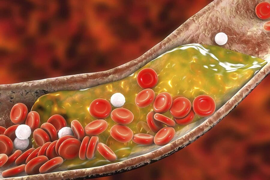 ldl cholesterol là gì