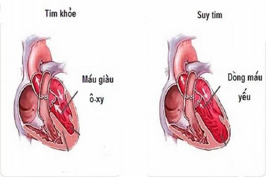 huyết áp bao nhiêu là cao