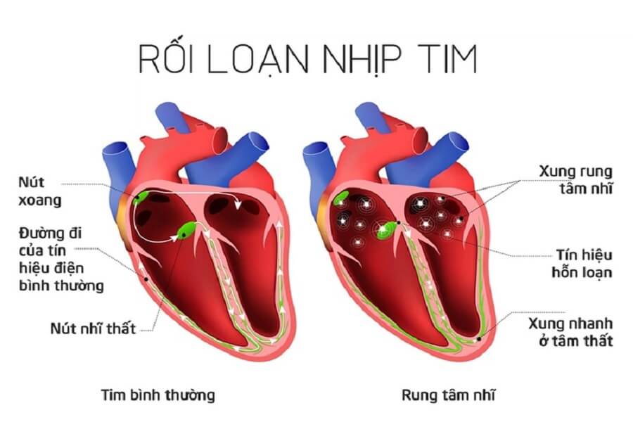 tim đập nhanh là bệnh gì