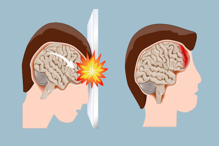 Tìm hiểu xuất huyết não là gì? Nguyên nhân, dấu hiệu xuất huyết não