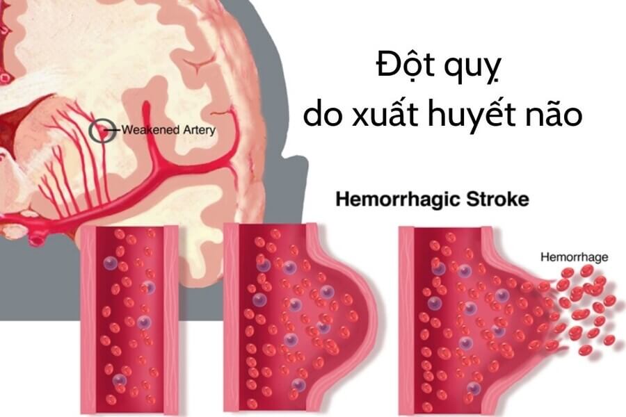 xuất huyết não là gì