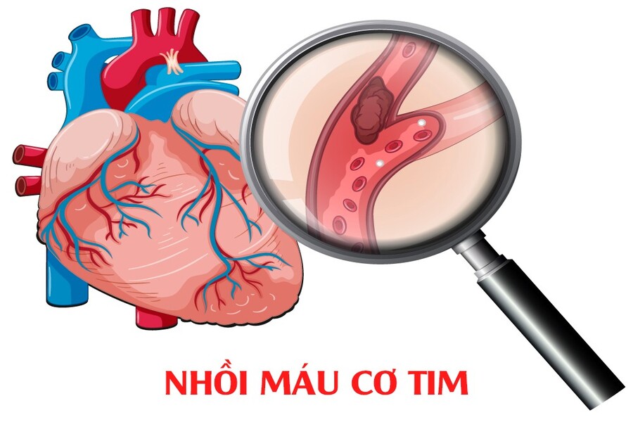 bệnh nhồi máu cơ tim