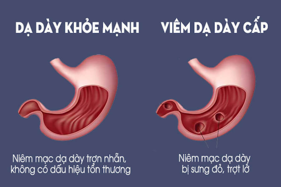 nguyên nhân đau dạ dày