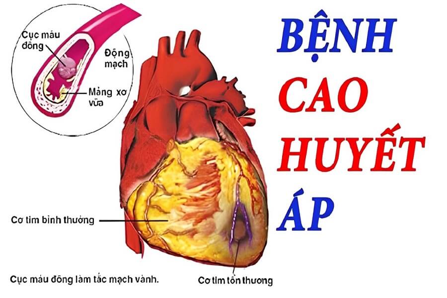 Dấu hiệu huyết áp cao