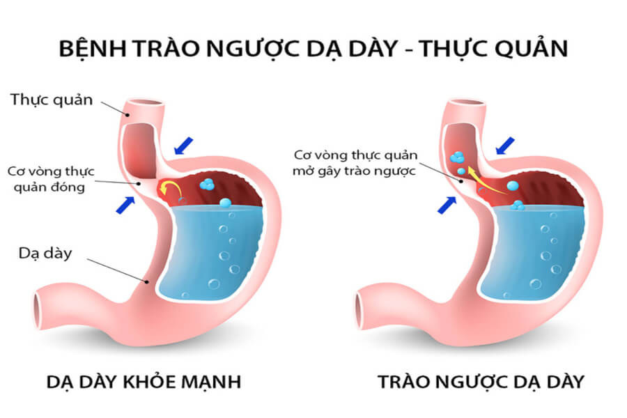 dấu hiệu trào ngược dạ dày