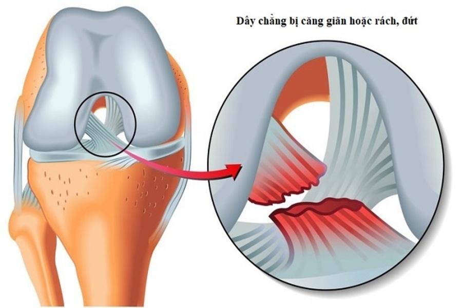 dây chằng đầu gối