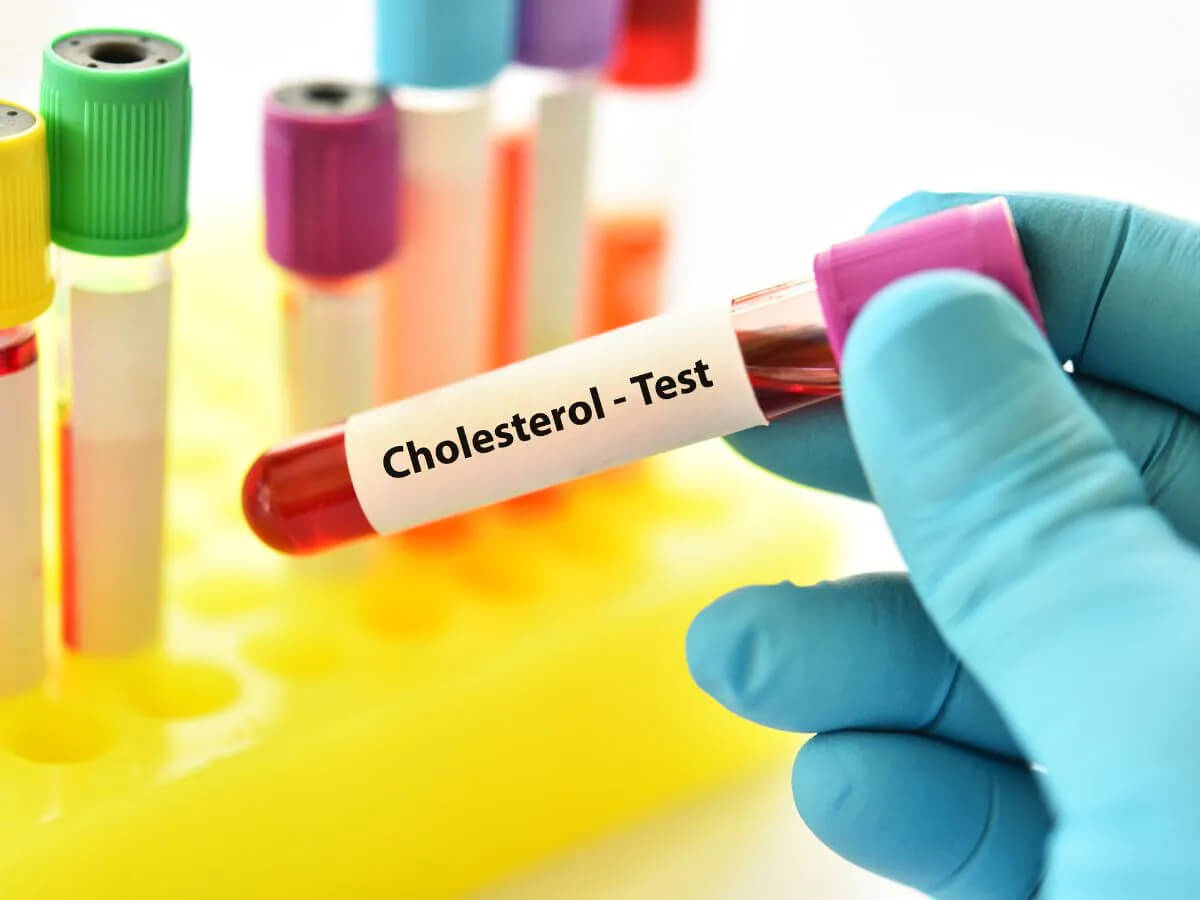 định lượng cholesterol toàn phần