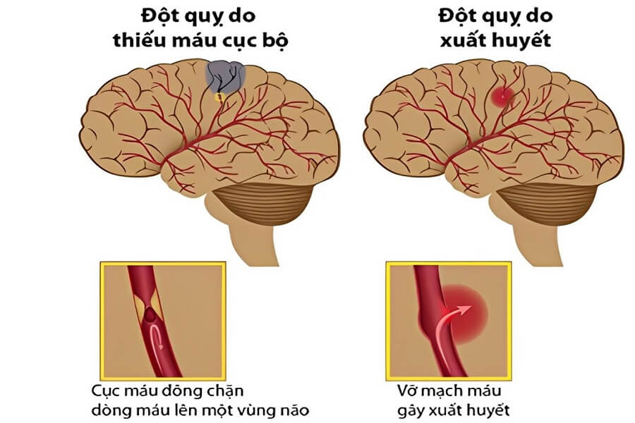 nguyên nhân gây đột quỵ