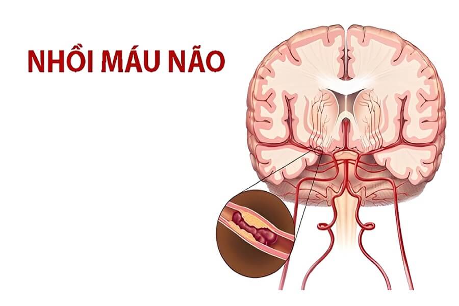 Nhồi máu não