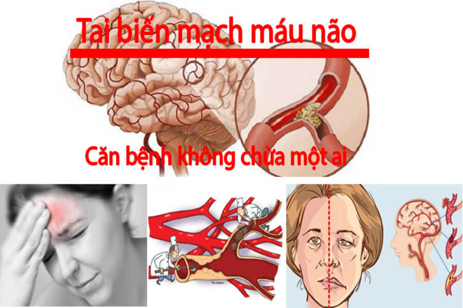 tai biến là gì