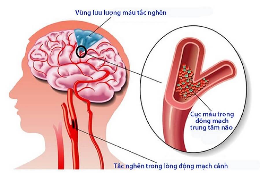 tai biến mạch máu não