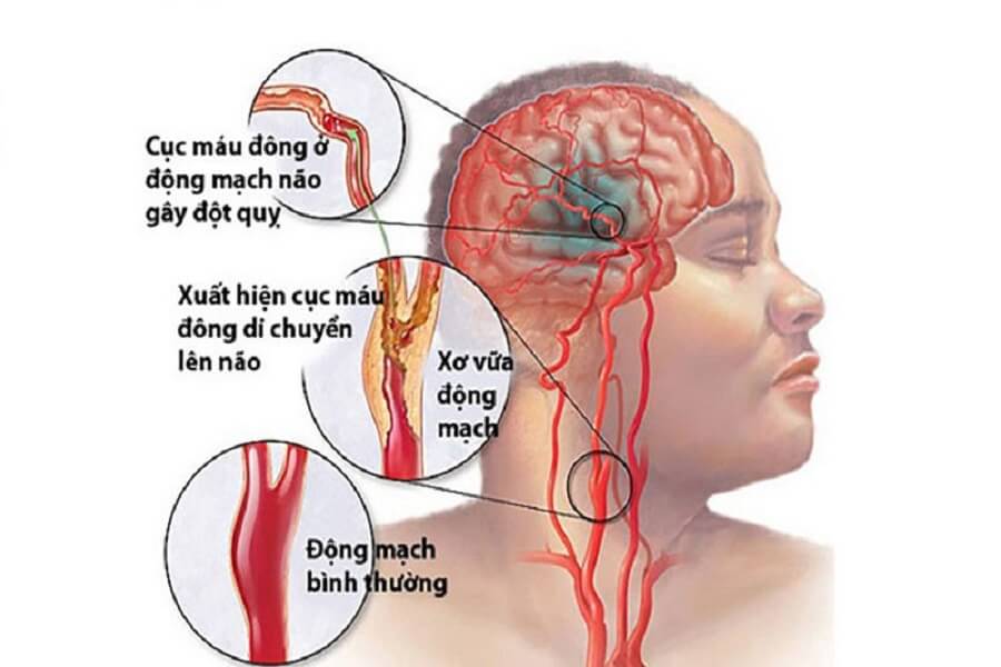 xuất huyết não sống được bao lâu