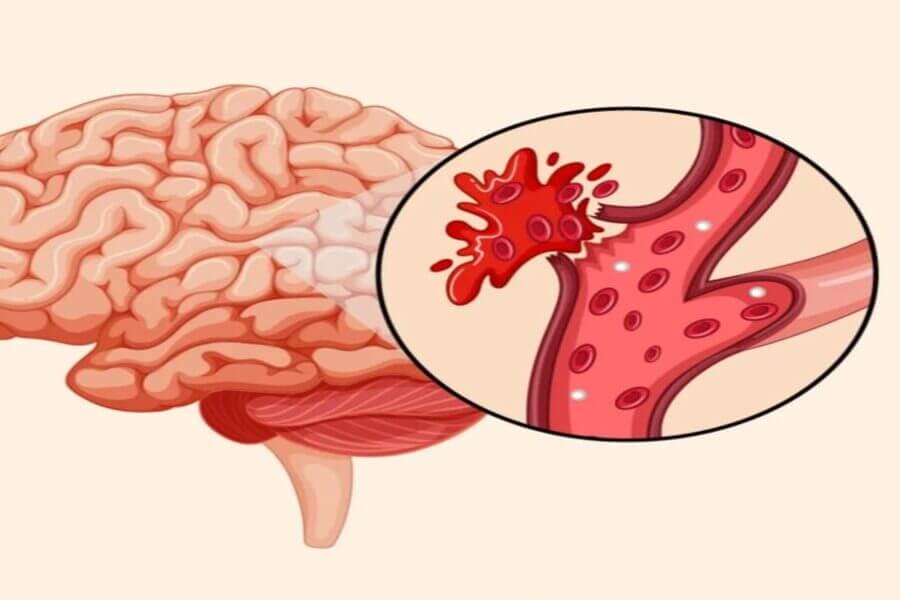 xuất huyết não có hồi phục được không