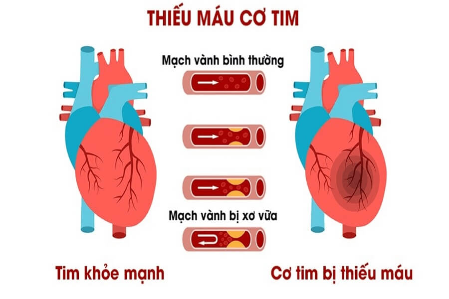 Bệnh thiếu máu cơ tim có chữa khỏi được không