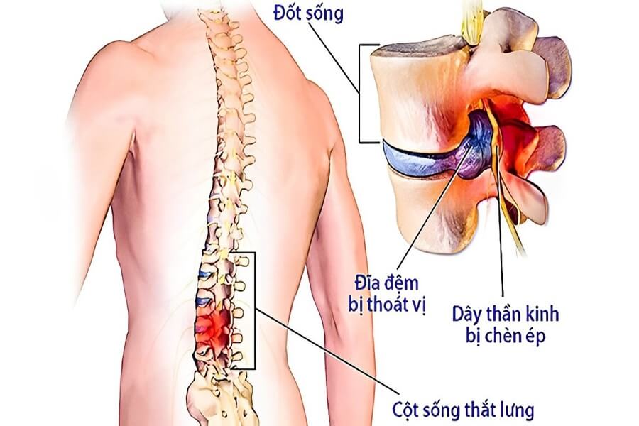 các vị trí đau sau lưng