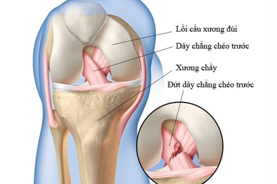 dấu hiệu đứt dây chằng