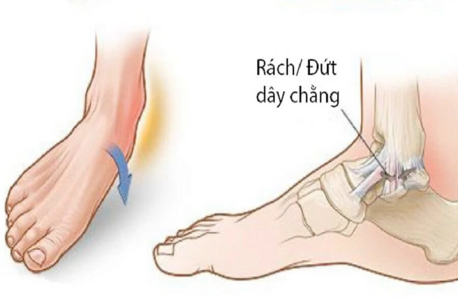 dây chằng cổ chân