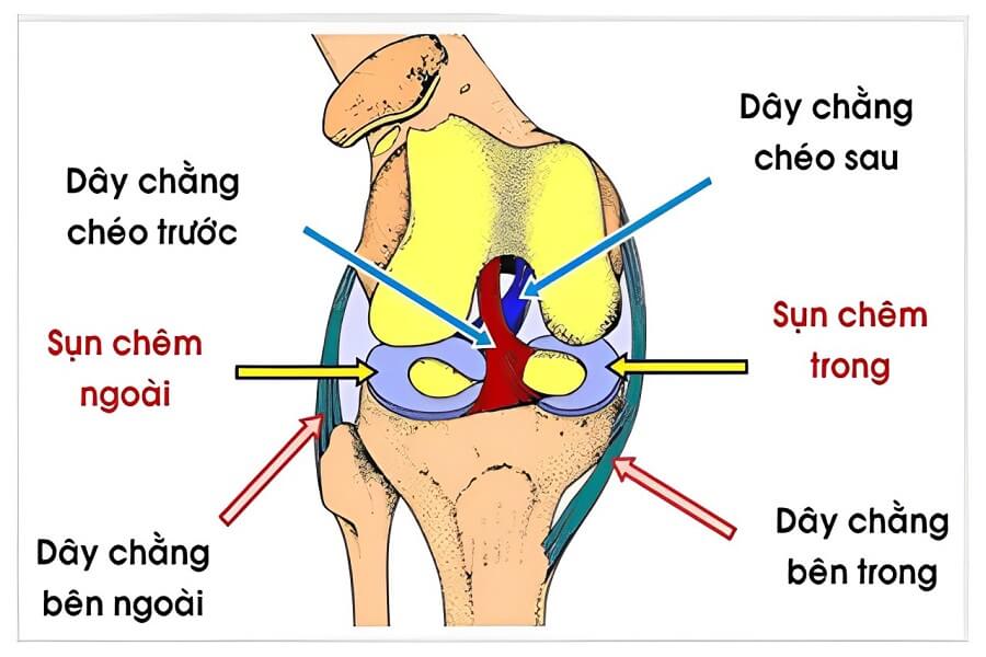 Đứt dây chằng