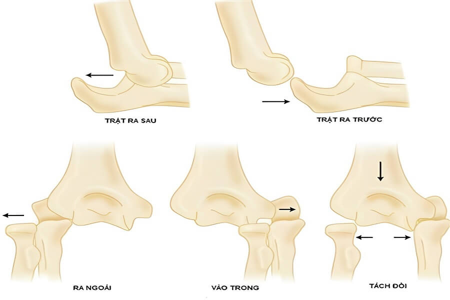 Trật khớp khuỷu tay