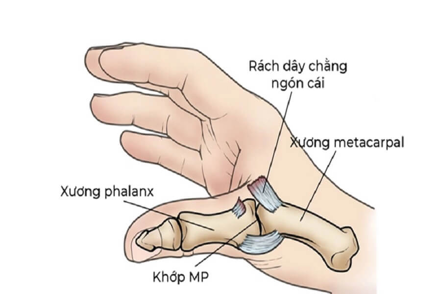 Trật khớp ngón tay