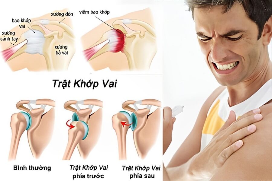 trật khớp vai bao lâu thì khỏi