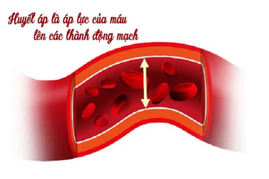 triệu chứng huyết áp cao