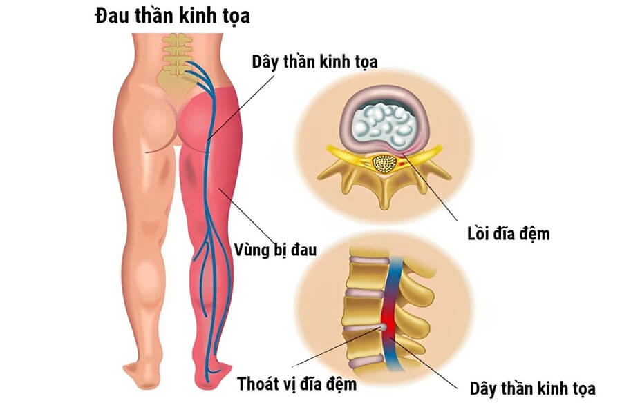 bị đau lưng dưới gần mông ở nam giới