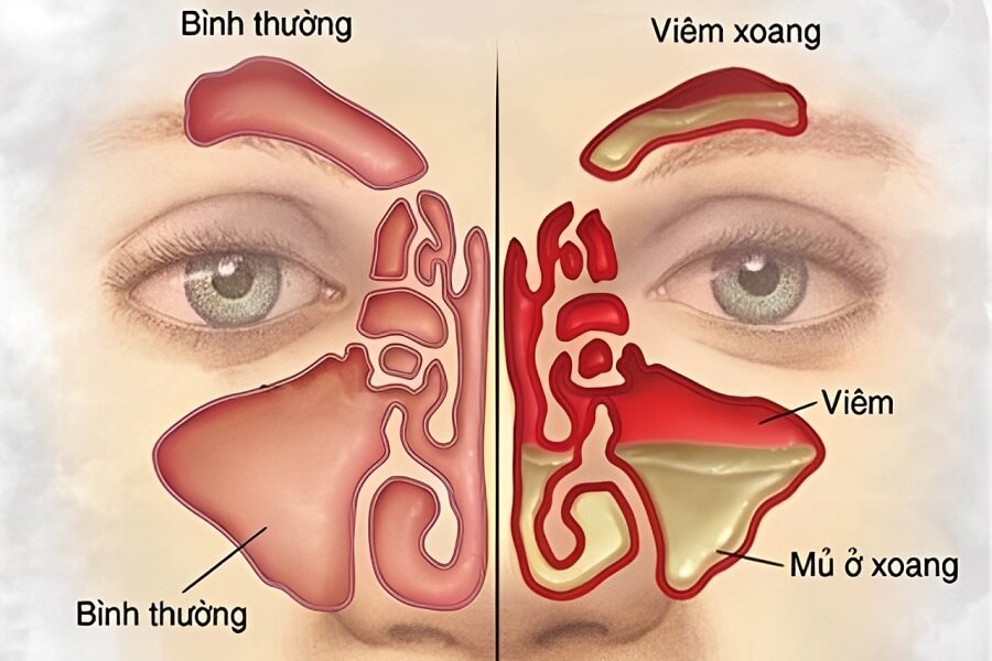 đau nửa đầu bên phải và nhức mắt