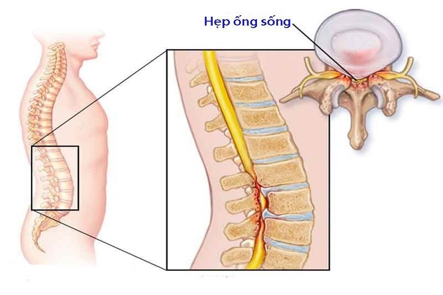 đau thắt lưng bên phải