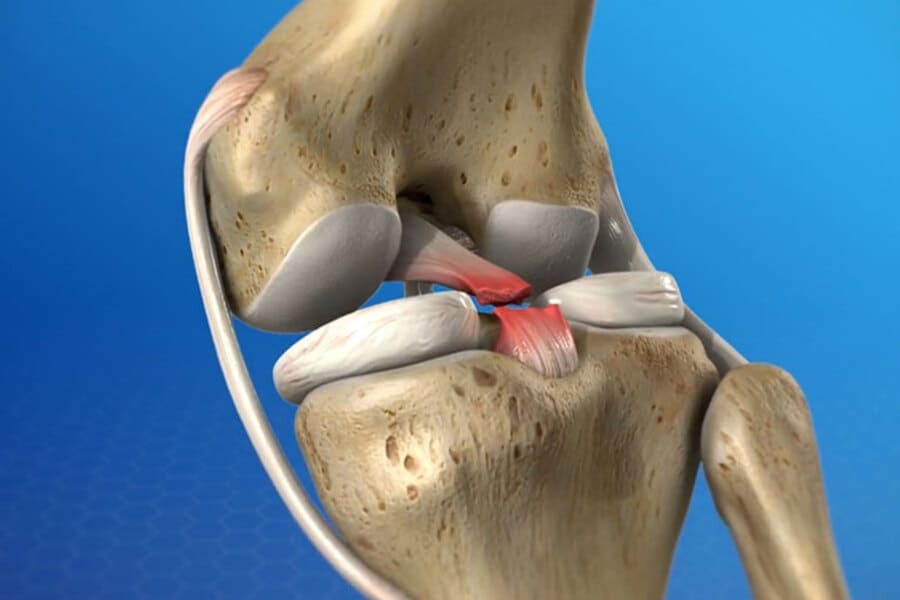 rách dây chằng có tự lành được không