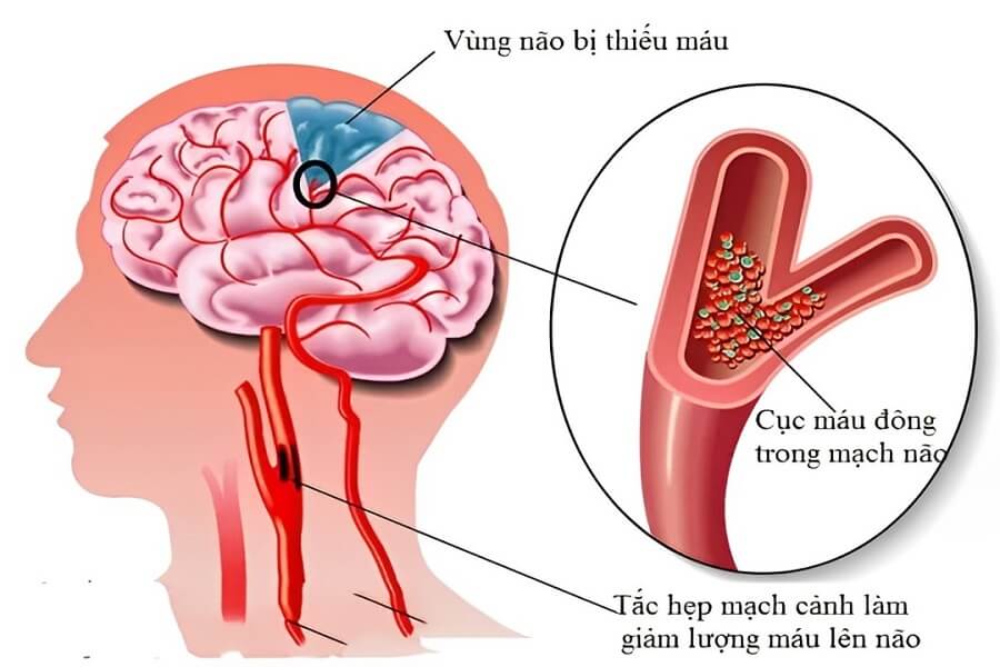 thiếu máu chóng mặt nên uống thuốc gì