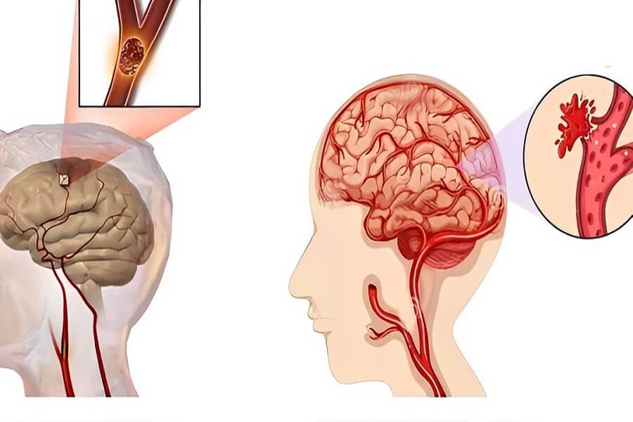 triệu chứng tai biến mạch máu não