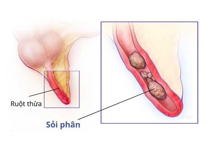ruột thừa đau bên nào