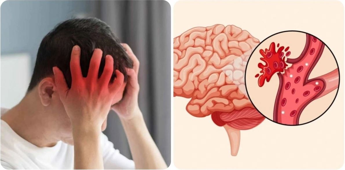 những dấu hiệu đột quỵ