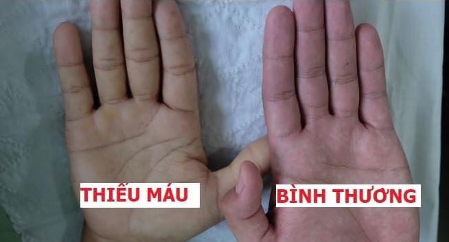 những dấu hiệu nhận biết bé bị thiếu sắt
