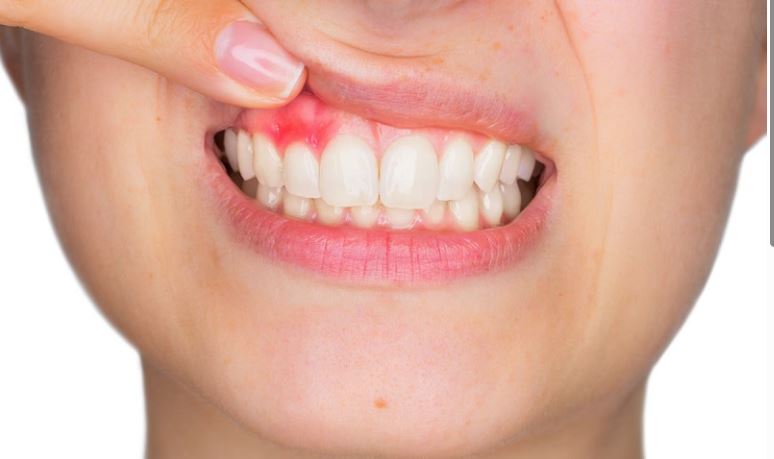 những dấu hiệu thiếu vitamin c