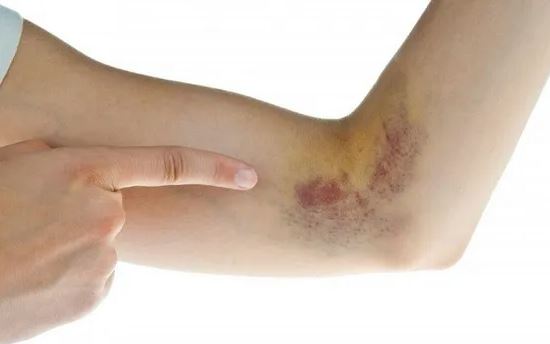 những dấu hiệu ung thư máu