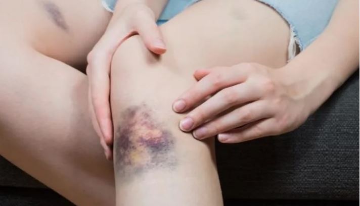 những dấu hiệu ung thư máu