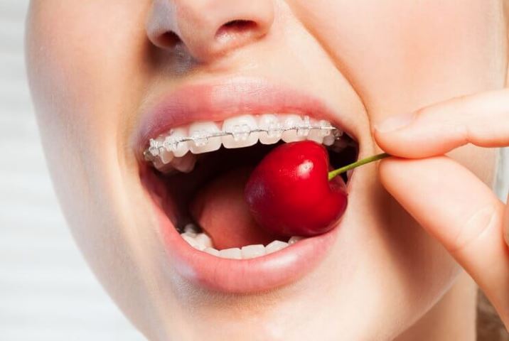 chế độ ăn uống khi niềng răng