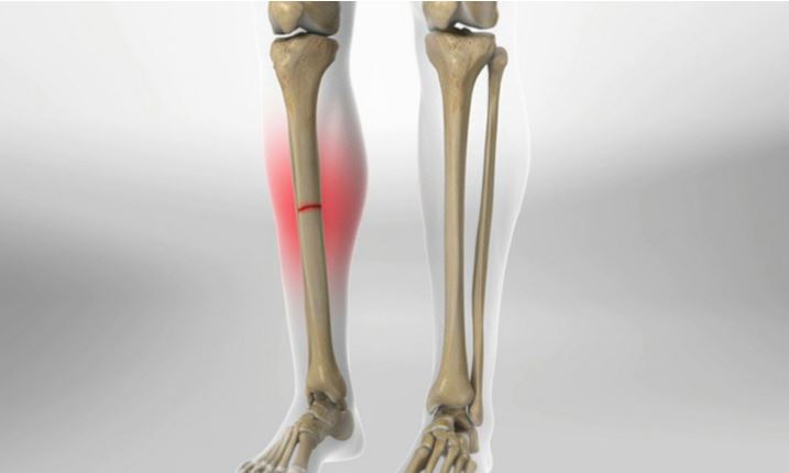 canxi cho người gãy xương